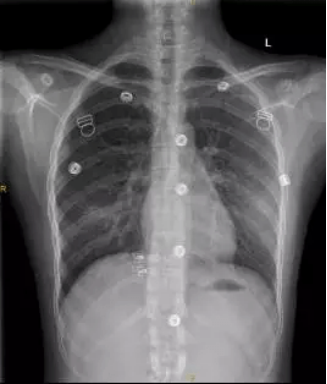 X光拍片为什么要等【影像科普】拍片为什么会要求脱衣服？_https://www.jmylbn.com_新闻资讯_第7张