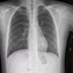 X光拍片为什么要等【影像科普】拍片为什么会要求脱衣服？_https://www.jmylbn.com_新闻资讯_第3张