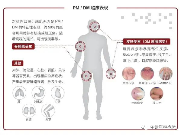 抗肌炎抗体谱检测