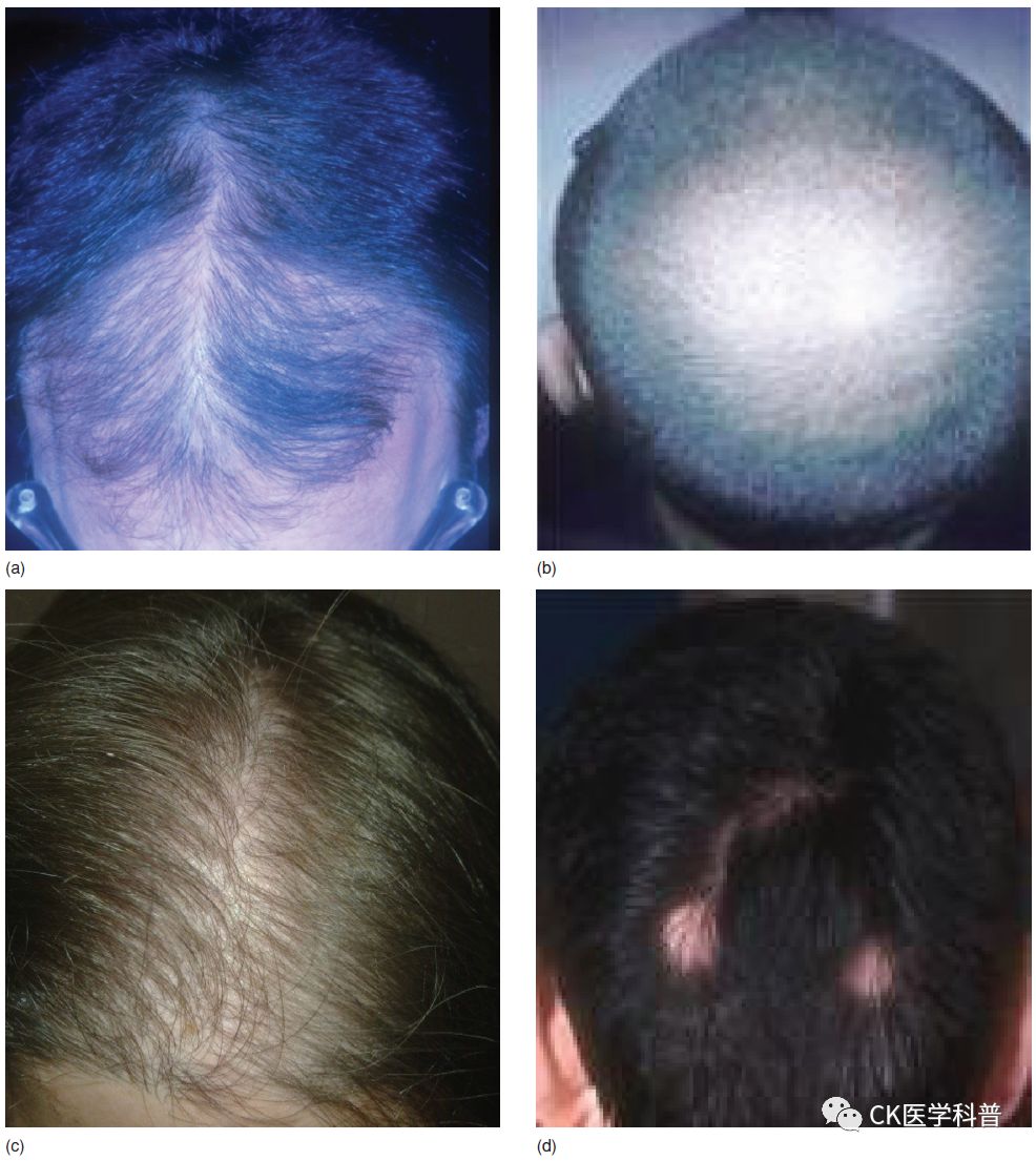 CK图像速览l内分泌疾病皮肤表现l03脱发（Alopecia）**