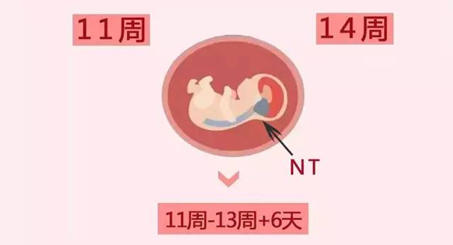 胎儿mt是什么检查什么疼吗妇幼科普：NT检查是什么？NT不过关宝宝就不能要吗？_https://www.jmylbn.com_新闻资讯_第9张