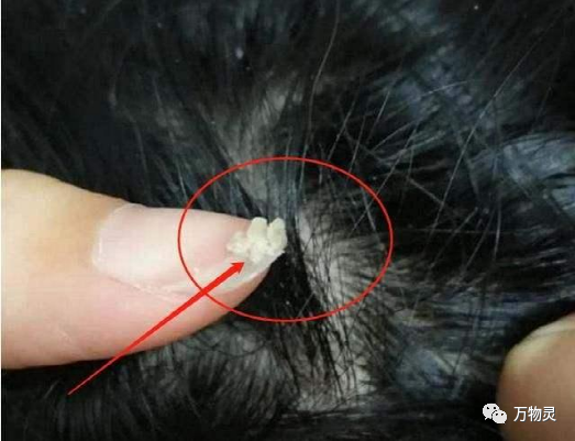 ​头皮上抠出来的白泥到底是啥？看完整个人都不好了