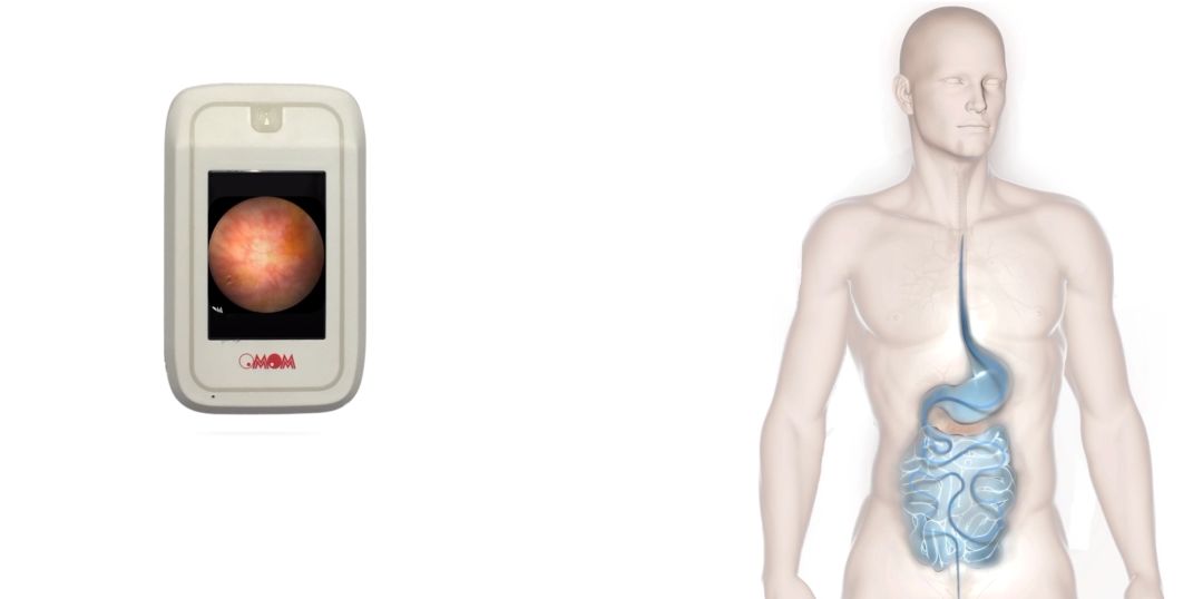 胶囊内镜品牌有哪些六大主流胶囊内镜，一次过饱眼福_https://www.jmylbn.com_新闻资讯_第6张