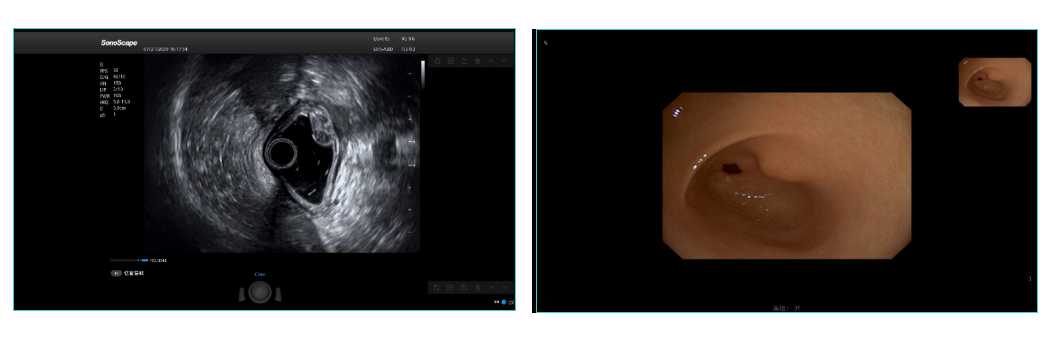 开立超声怎么导出图像国产首台！开立医疗超声内镜EG-UR5正式获批上市_https://www.jmylbn.com_新闻资讯_第3张