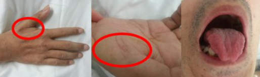 为什么会出现呼吸机依赖以呼吸困难首诊的肌萎缩侧索硬化症及呼吸机依赖原因分析_https://www.jmylbn.com_新闻资讯_第13张