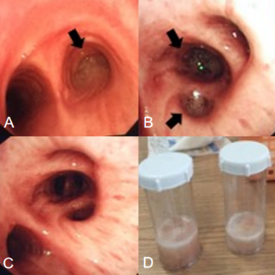 为什么会出现呼吸机依赖以呼吸困难首诊的肌萎缩侧索硬化症及呼吸机依赖原因分析_https://www.jmylbn.com_新闻资讯_第8张