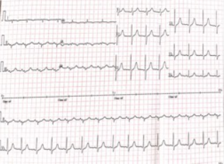 为什么会出现呼吸机依赖以呼吸困难首诊的肌萎缩侧索硬化症及呼吸机依赖原因分析_https://www.jmylbn.com_新闻资讯_第6张