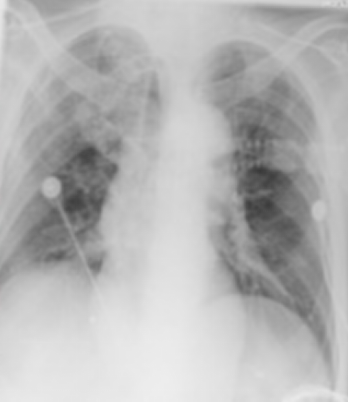 为什么会出现呼吸机依赖以呼吸困难首诊的肌萎缩侧索硬化症及呼吸机依赖原因分析_https://www.jmylbn.com_新闻资讯_第7张