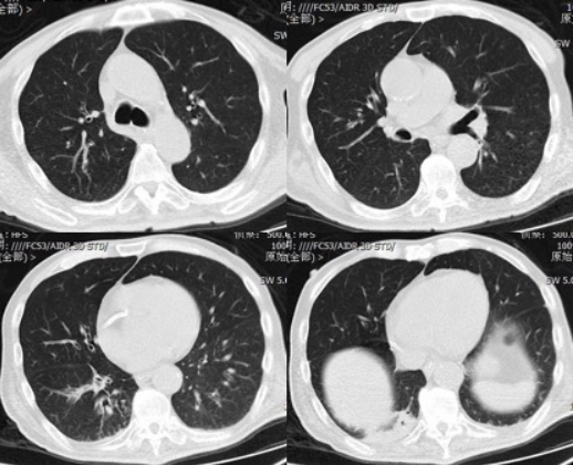 为什么会出现呼吸机依赖以呼吸困难首诊的肌萎缩侧索硬化症及呼吸机依赖原因分析_https://www.jmylbn.com_新闻资讯_第12张