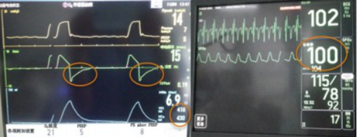 为什么会出现呼吸机依赖以呼吸困难首诊的肌萎缩侧索硬化症及呼吸机依赖原因分析_https://www.jmylbn.com_新闻资讯_第4张