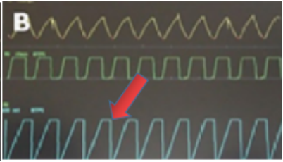 为什么呼吸机人机同步人机同步性概述_https://www.jmylbn.com_新闻资讯_第7张