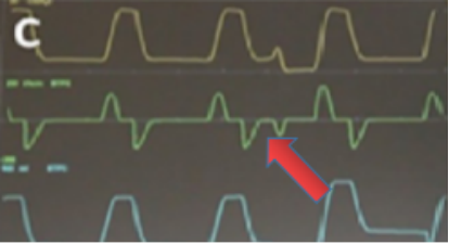 为什么呼吸机人机同步人机同步性概述_https://www.jmylbn.com_新闻资讯_第8张