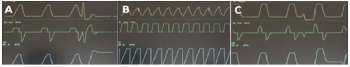 为什么呼吸机人机同步人机同步性概述_https://www.jmylbn.com_新闻资讯_第5张