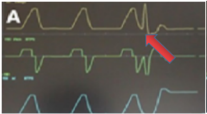为什么呼吸机人机同步人机同步性概述_https://www.jmylbn.com_新闻资讯_第6张