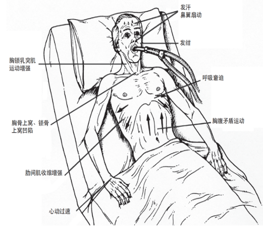 为什么呼吸机人机同步人机同步性概述_https://www.jmylbn.com_新闻资讯_第4张