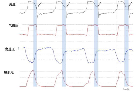 为什么呼吸机人机同步人机不同步的监测与识别_https://www.jmylbn.com_新闻资讯_第18张