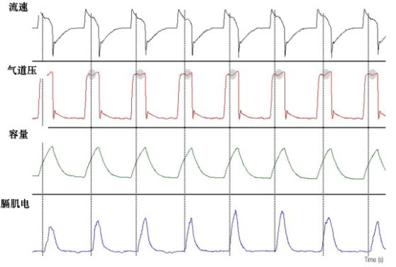 为什么呼吸机人机同步人机不同步的监测与识别_https://www.jmylbn.com_新闻资讯_第17张