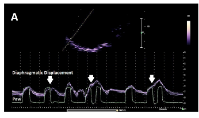 为什么呼吸机人机同步人机不同步的监测与识别_https://www.jmylbn.com_新闻资讯_第23张