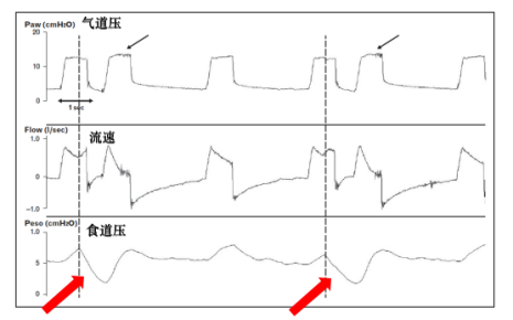 为什么呼吸机人机同步人机不同步的监测与识别_https://www.jmylbn.com_新闻资讯_第11张