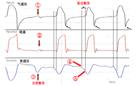 为什么呼吸机人机同步人机不同步的监测与识别_https://www.jmylbn.com_新闻资讯_第8张