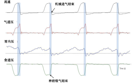 为什么呼吸机人机同步人机不同步的监测与识别_https://www.jmylbn.com_新闻资讯_第13张
