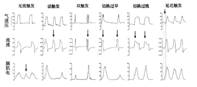 为什么呼吸机人机同步人机不同步的监测与识别_https://www.jmylbn.com_新闻资讯_第20张