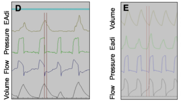 为什么呼吸机人机同步人机不同步的监测与识别_https://www.jmylbn.com_新闻资讯_第19张
