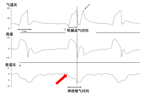 为什么呼吸机人机同步人机不同步的监测与识别_https://www.jmylbn.com_新闻资讯_第12张