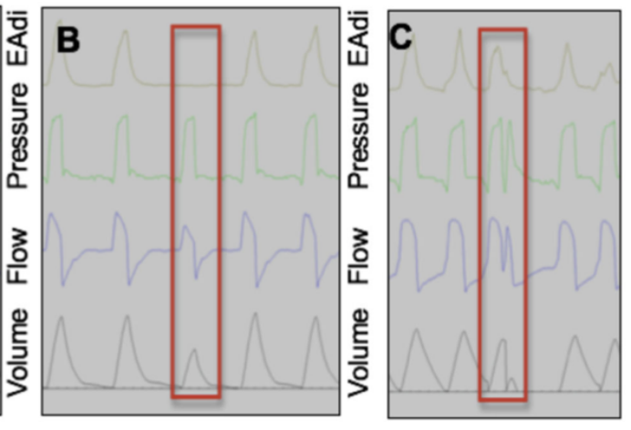 为什么呼吸机人机同步人机不同步的监测与识别_https://www.jmylbn.com_新闻资讯_第16张