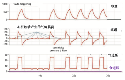 为什么呼吸机人机同步人机不同步的监测与识别_https://www.jmylbn.com_新闻资讯_第9张