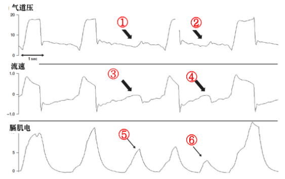 为什么呼吸机人机同步人机不同步的监测与识别_https://www.jmylbn.com_新闻资讯_第15张
