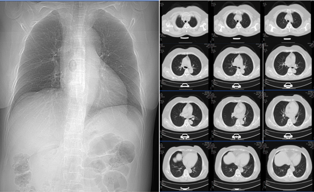 新冠肺炎的肺部图片