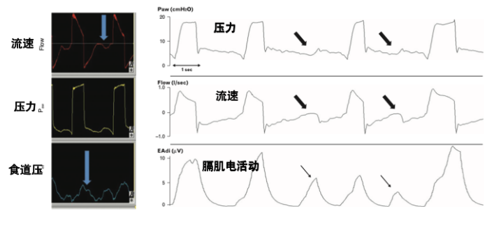 为什么呼吸机人机同步人机不同步常见类型及处理策略_https://www.jmylbn.com_新闻资讯_第10张