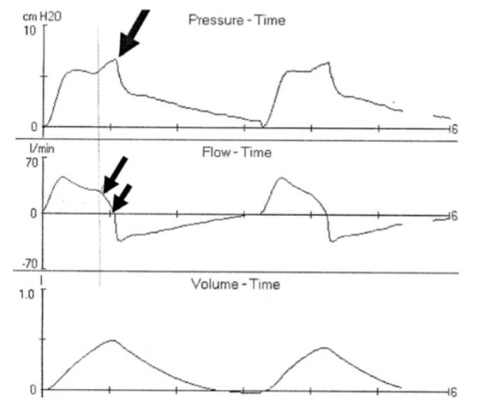 为什么呼吸机人机同步人机不同步常见类型及处理策略_https://www.jmylbn.com_新闻资讯_第30张