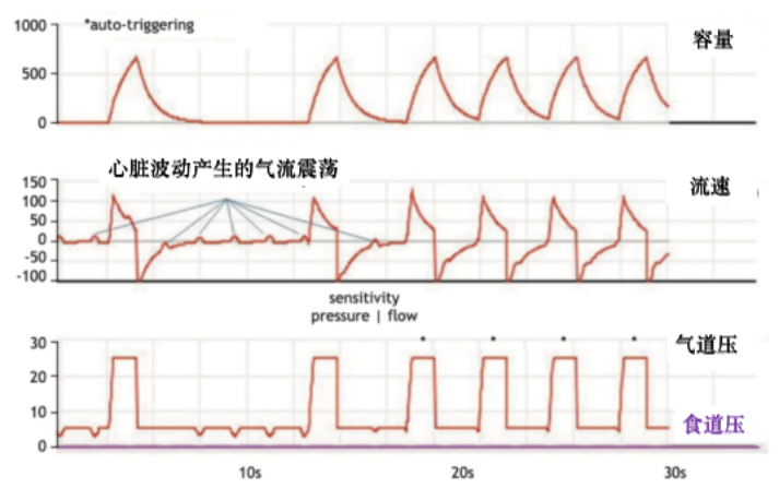 为什么呼吸机人机同步人机不同步常见类型及处理策略_https://www.jmylbn.com_新闻资讯_第13张