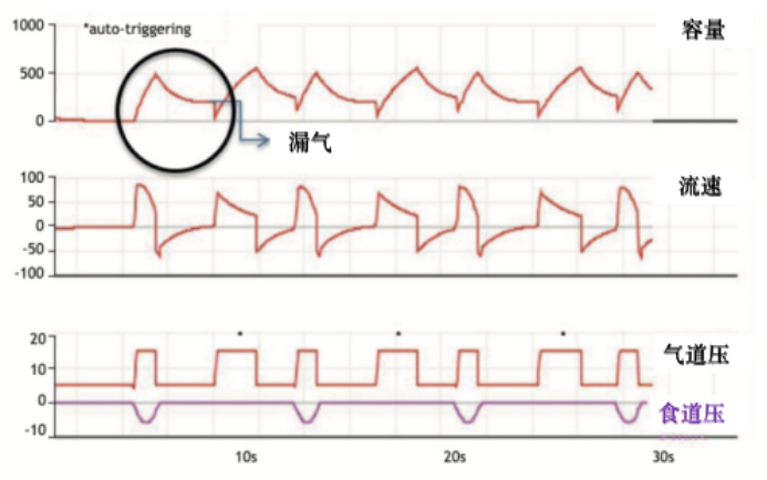 为什么呼吸机人机同步人机不同步常见类型及处理策略_https://www.jmylbn.com_新闻资讯_第14张
