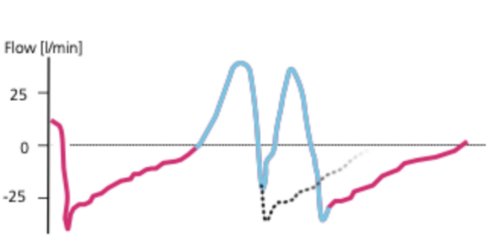 为什么呼吸机人机同步人机不同步常见类型及处理策略_https://www.jmylbn.com_新闻资讯_第22张