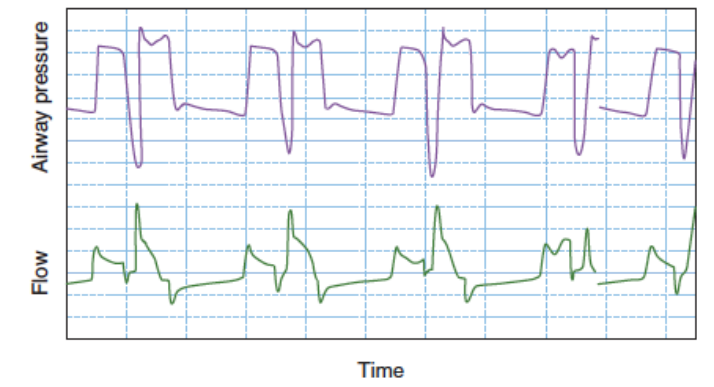 为什么呼吸机人机同步人机不同步常见类型及处理策略_https://www.jmylbn.com_新闻资讯_第24张