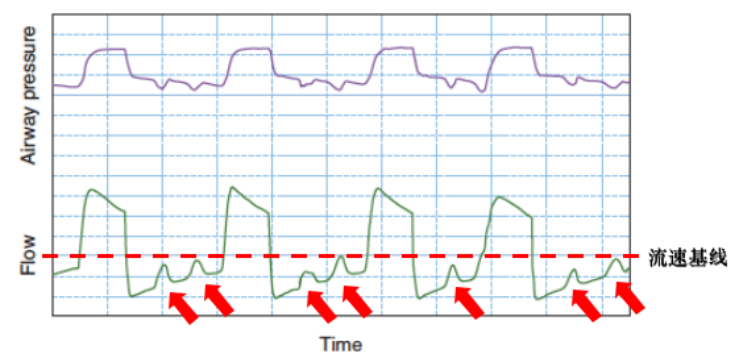 为什么呼吸机人机同步人机不同步常见类型及处理策略_https://www.jmylbn.com_新闻资讯_第6张