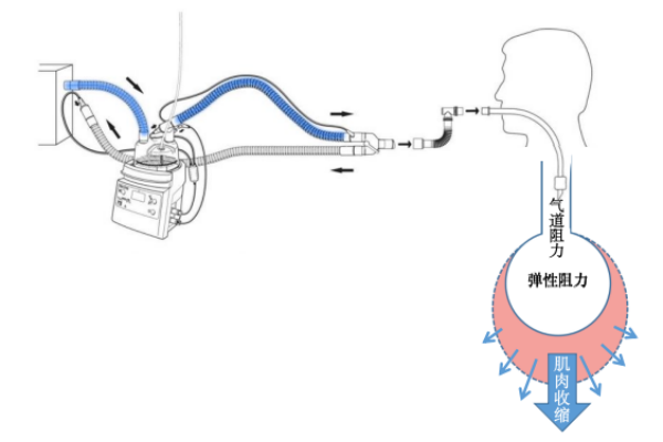 为什么呼吸机人机同步人机不同步常见类型及处理策略_https://www.jmylbn.com_新闻资讯_第3张
