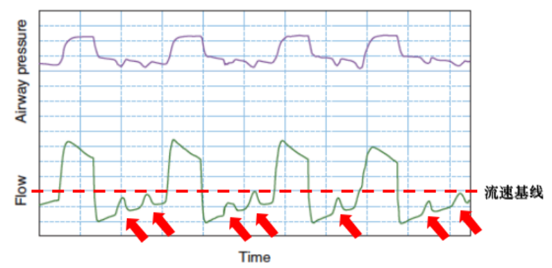 为什么呼吸机人机同步人机不同步常见类型及处理策略_https://www.jmylbn.com_新闻资讯_第11张