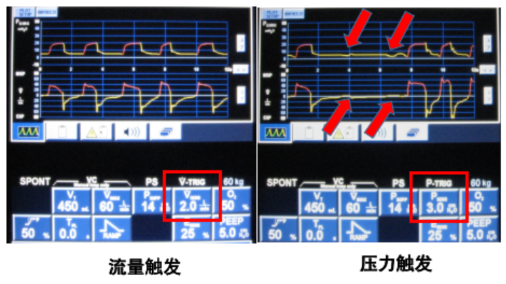 为什么呼吸机人机同步人机不同步常见类型及处理策略_https://www.jmylbn.com_新闻资讯_第8张