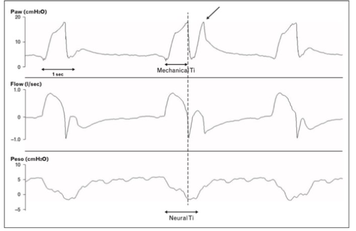 为什么呼吸机人机同步人机不同步常见类型及处理策略_https://www.jmylbn.com_新闻资讯_第23张