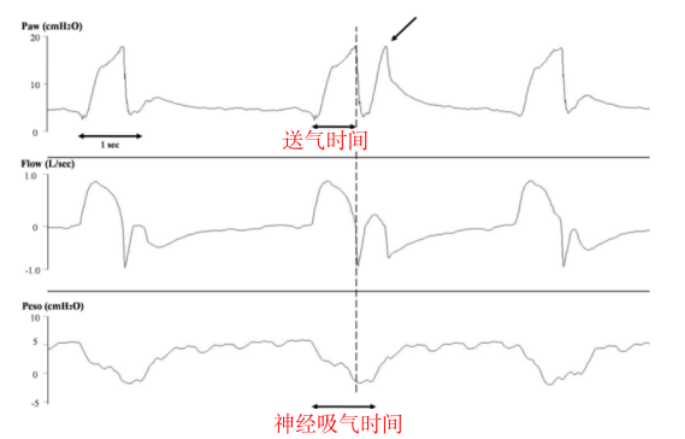 为什么呼吸机人机同步人机不同步常见类型及处理策略_https://www.jmylbn.com_新闻资讯_第29张