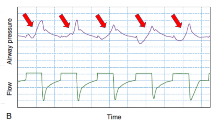 为什么呼吸机人机同步人机不同步常见类型及处理策略_https://www.jmylbn.com_新闻资讯_第18张