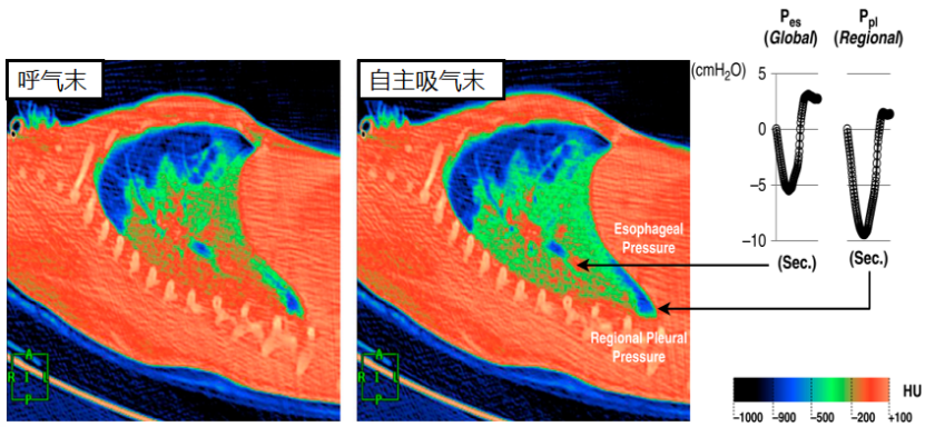 呼吸机怎么看自主呼吸ARDS自主呼吸的那些事-1_https://www.jmylbn.com_新闻资讯_第3张