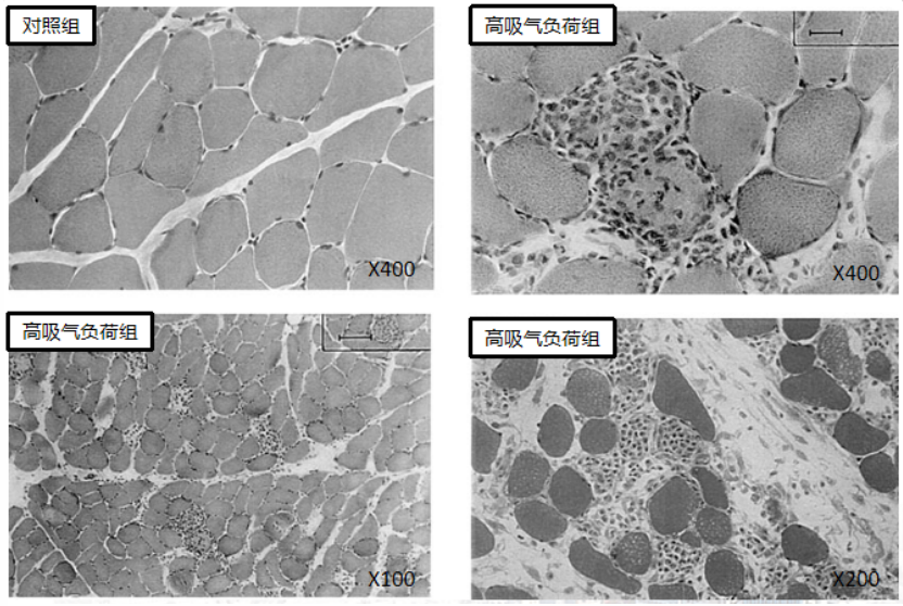 呼吸机怎么看自主呼吸ARDS自主呼吸的那些事-1_https://www.jmylbn.com_新闻资讯_第4张
