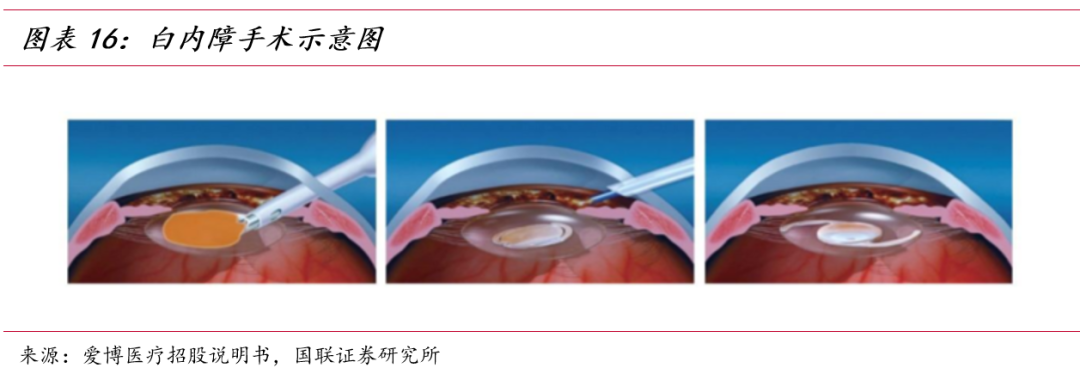 重庆爱尔眼科全飞秒价格2022_重庆爱尔眼科医院飞秒多少钱_重庆爱尔眼科近视手术价格