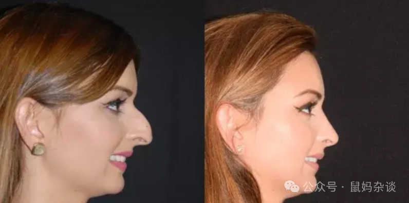 伊朗人热衷于鼻子整形