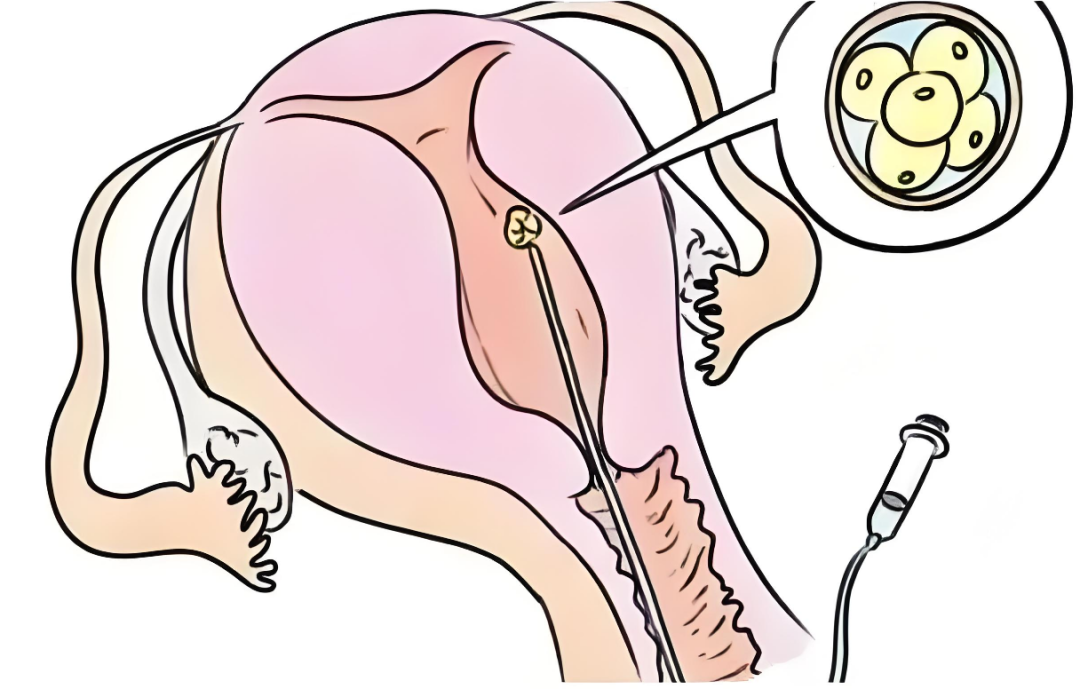 取卵针长什么样面对辣么长的取卵针，无痛取卵究竟靠不靠谱？_https://www.jmylbn.com_新闻资讯_第4张